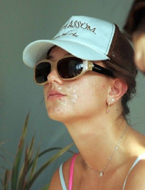 britney spears granos acne